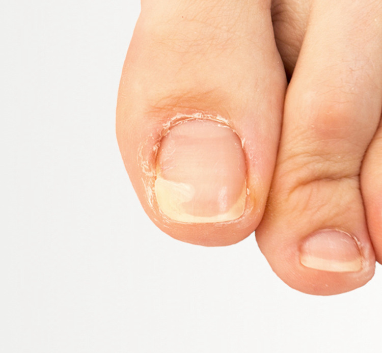 Big toenail infected with fungus