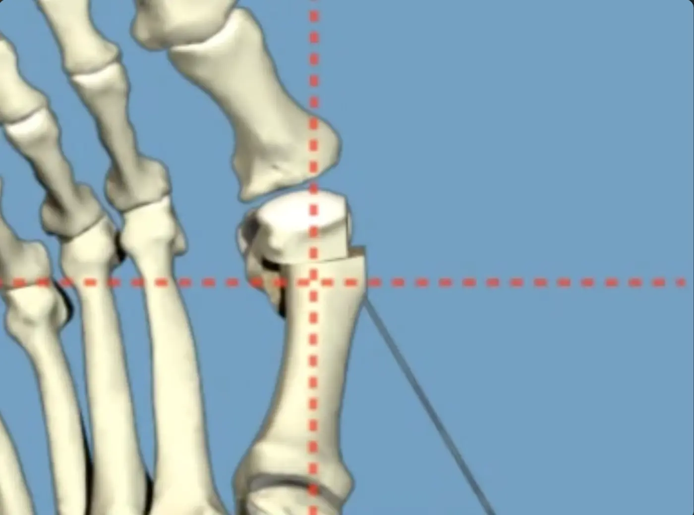 Hallux Valgus, Dr Hobeychi, podiatre