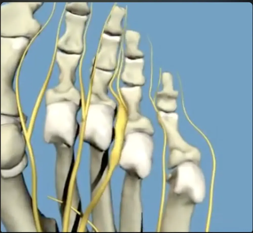 Morton's Neuromas
