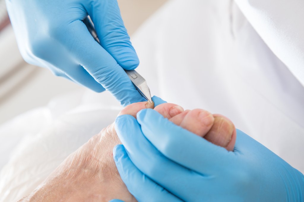 A toenail infected with fungus