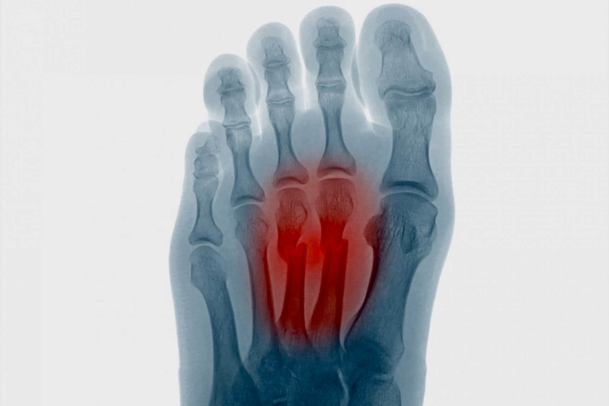 Radiologie du pied