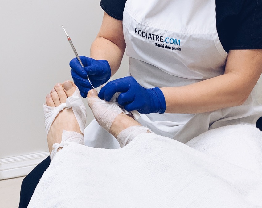 Foot bunion