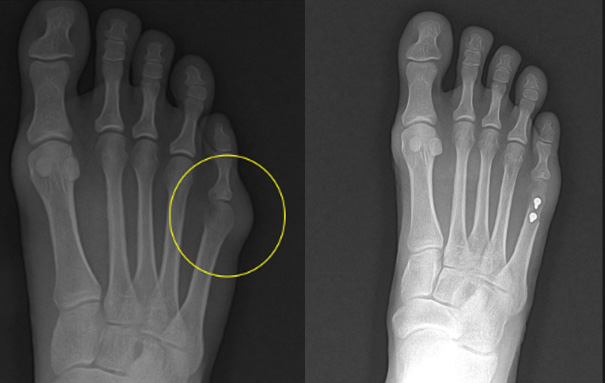 X-ray of a foot