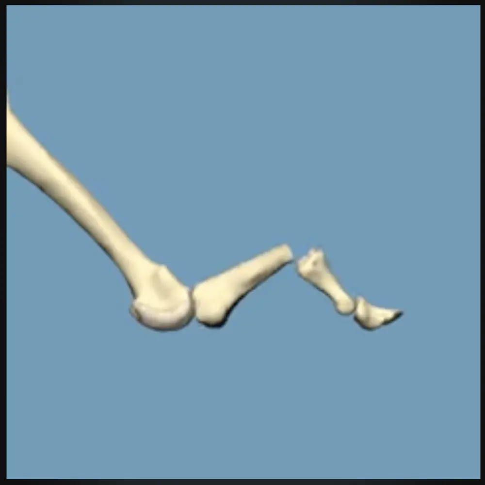 Hammer toe
