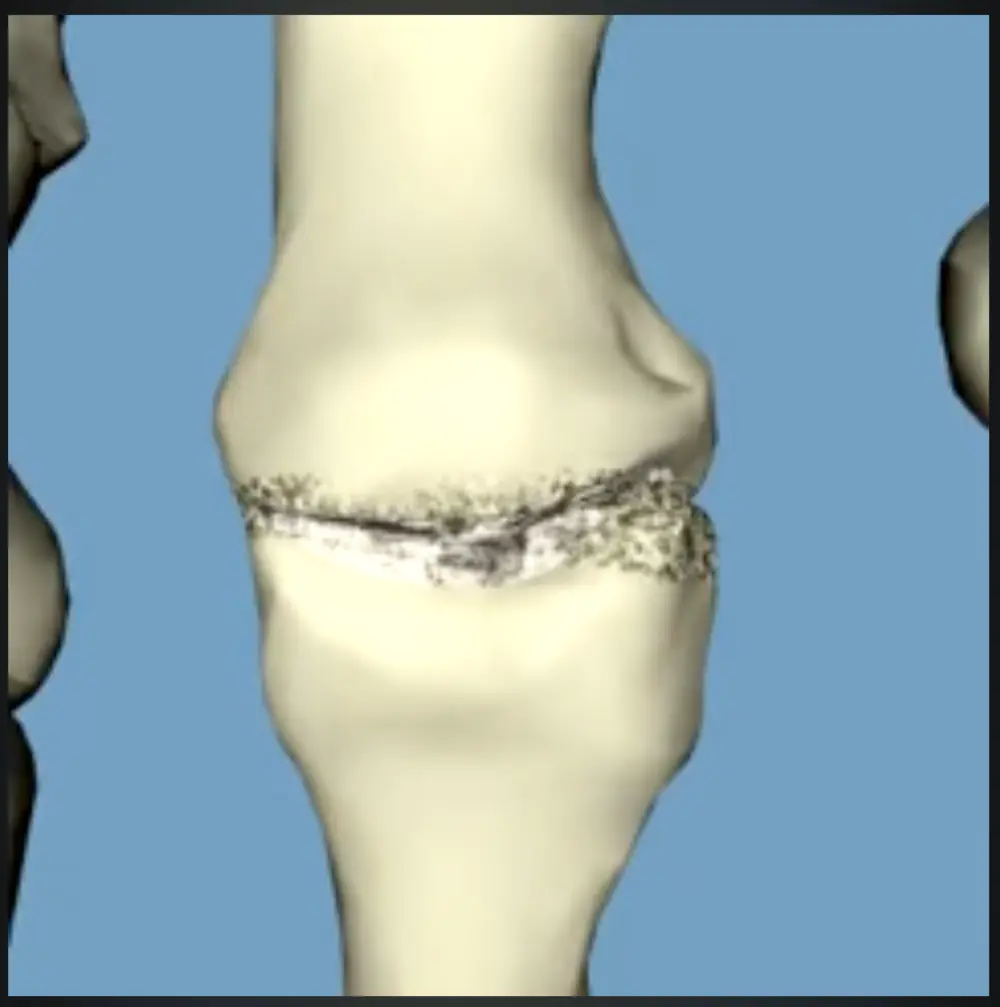 Hammer toe