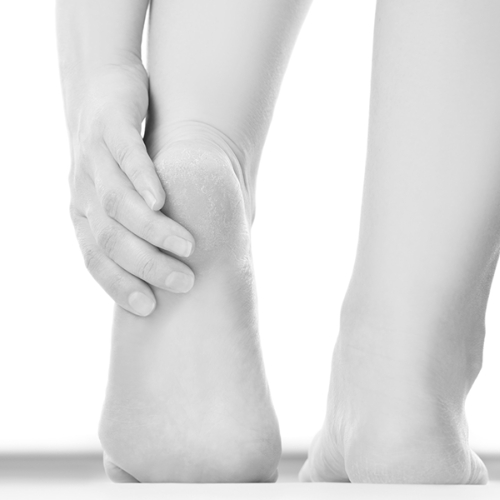 Quoi Faire Contre les Cors au Pieds?