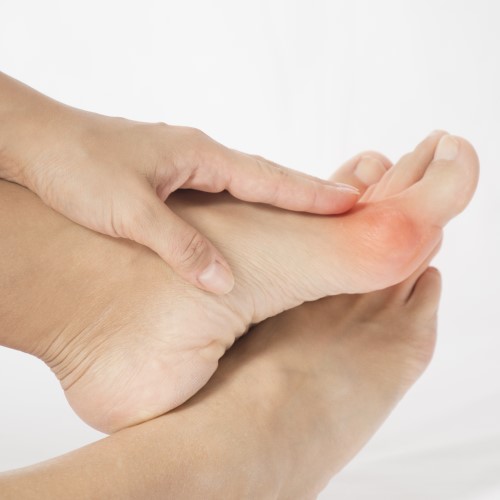 How to Relieve Painful Bunions Without Surgery